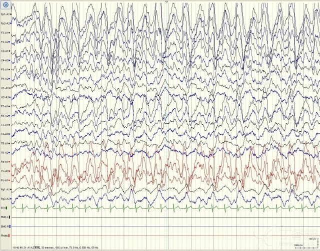 脑电图正常但是抽搐图片