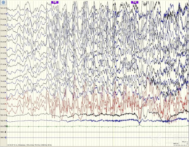 热性惊厥脑电图图片