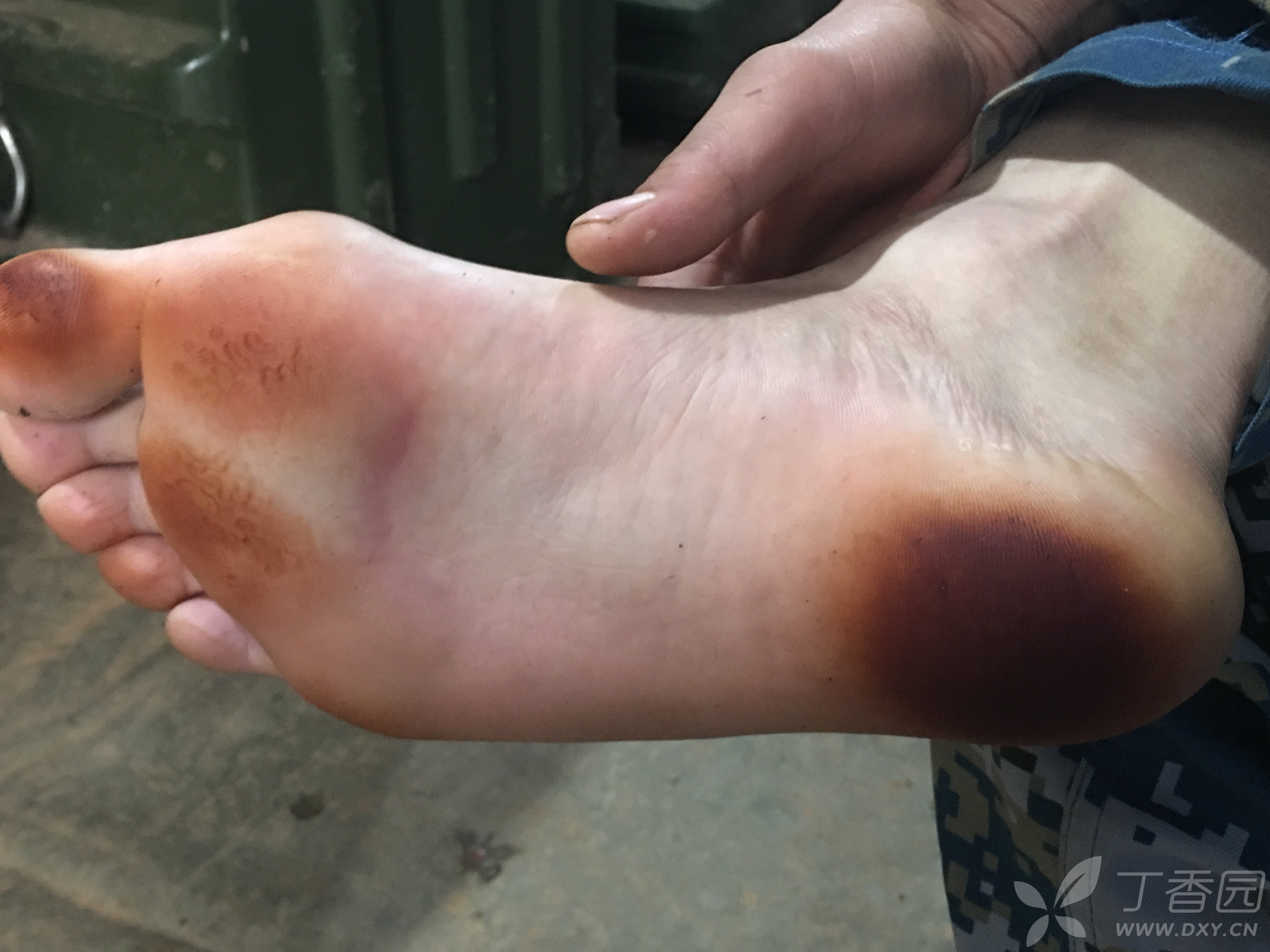 足癣?大家帮忙看一下