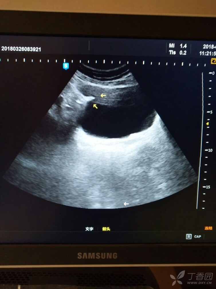 膀胱条状高回声 - 超声医学讨论版 -丁香园论坛