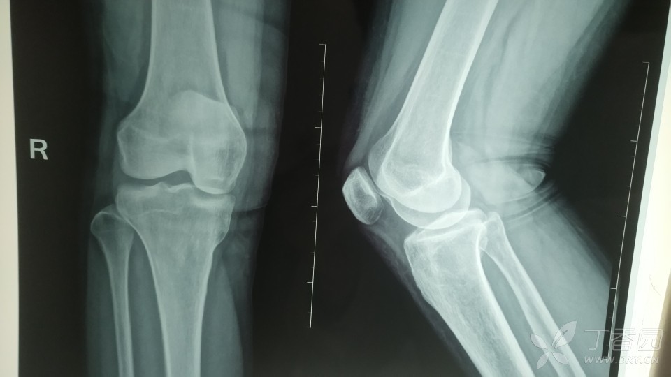 正常膝关节ct片图图片