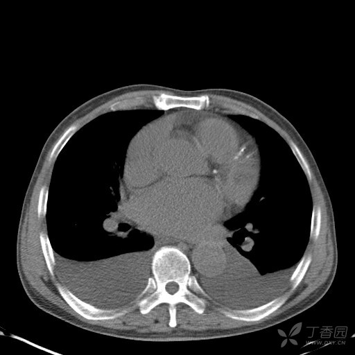 卧位胸片中胸腔积液的探讨 [精华]