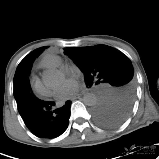 胸腔积液胸片图片