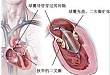 阜外医院吴永健等研究称：我国二尖瓣反流首因是退行性病变