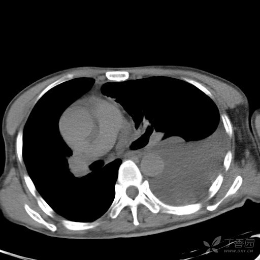 照肺积水的CT图图片