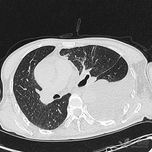 照肺积水的CT图图片