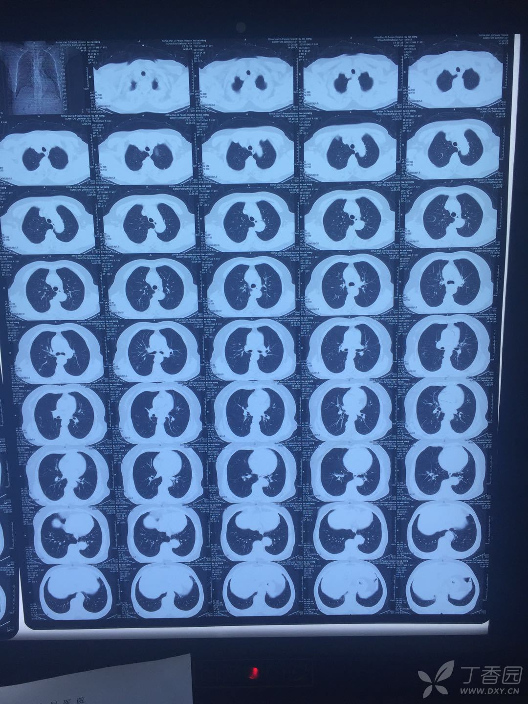 女,66岁,胸闷咳嗽气短,前后间隔4个月ct平扫,请各位老师帮忙看下,谢谢