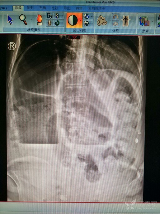 腹部ct及腹部立位片如下图.