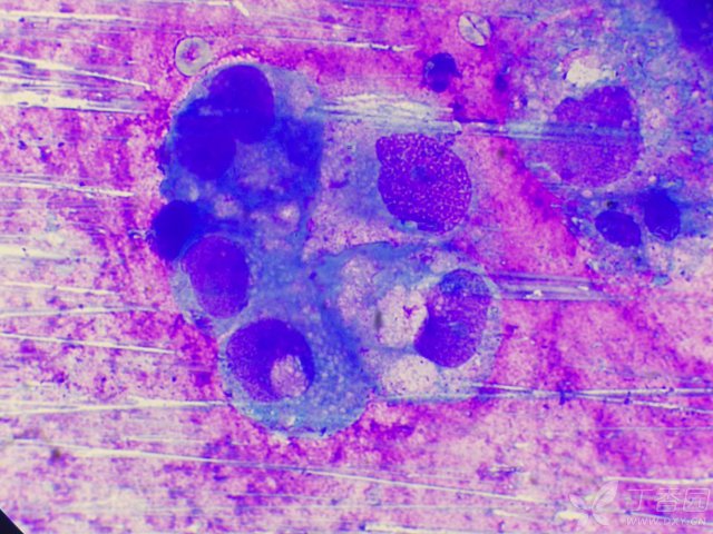 什么是恶性肿瘤细胞 3269531630649596512-8w.jpg!w640