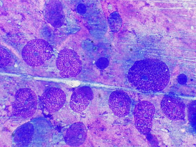 什么是恶性肿瘤细胞 3269531637092380646-8w.jpg!w640