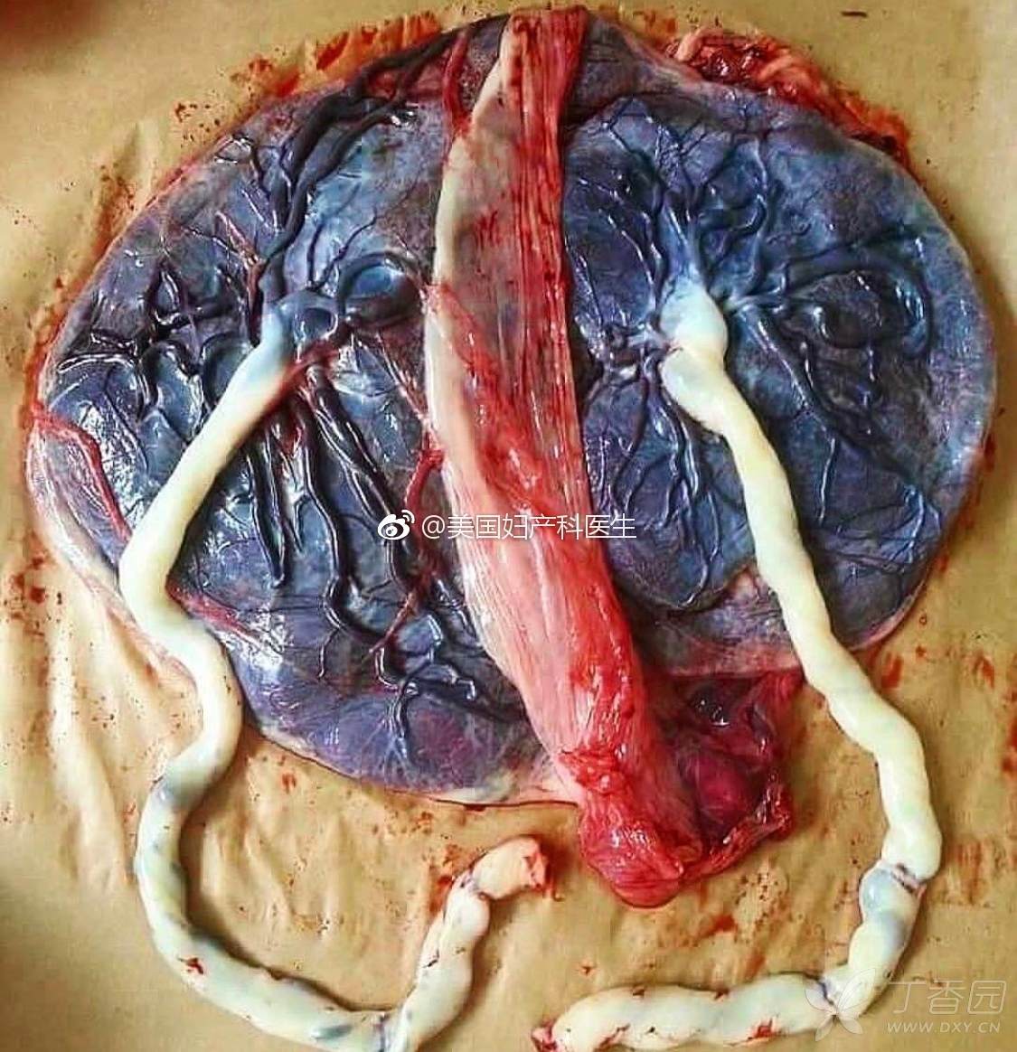 一个漂亮的双胞胎胎盘(符合这几个标准才算) - 丁香园论坛