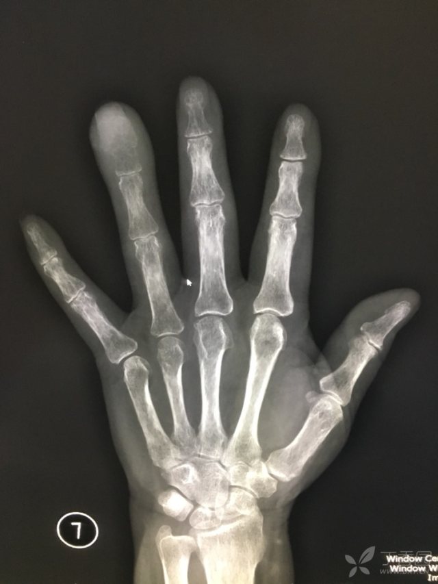 相关疾病: 痛风 患者:女,68岁,左手环指远节指骨破坏,病史不详