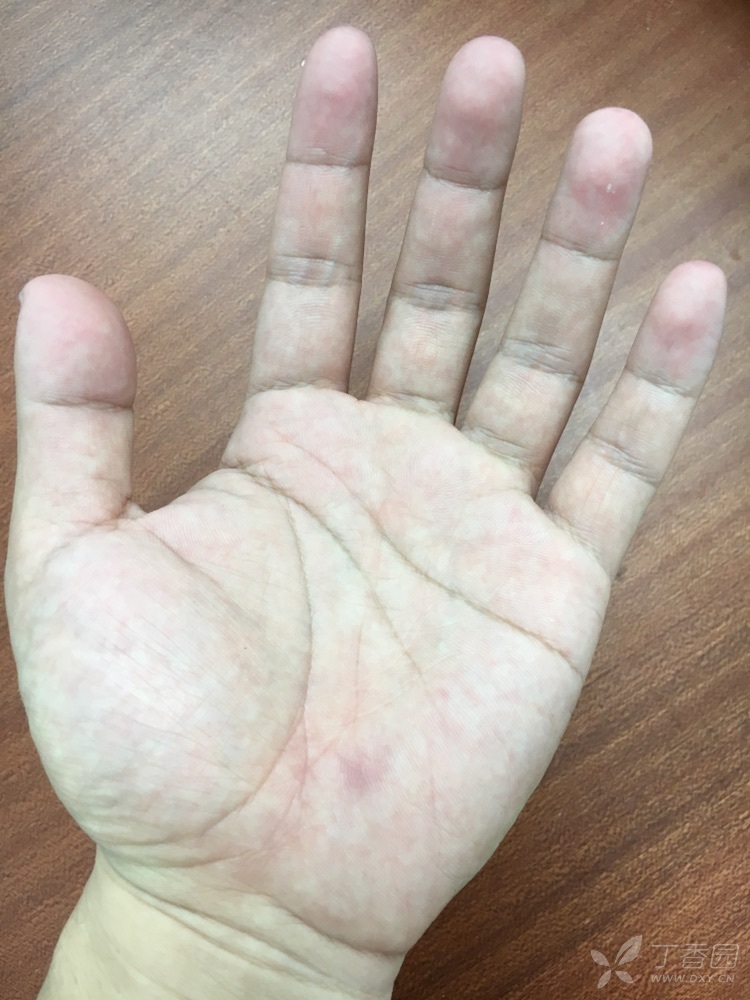 肝炎手掌红斑图片图片