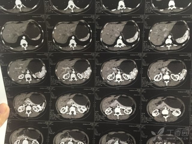 什么情况需要做增强ct 3270282049483065474-16w.jpg!w640
