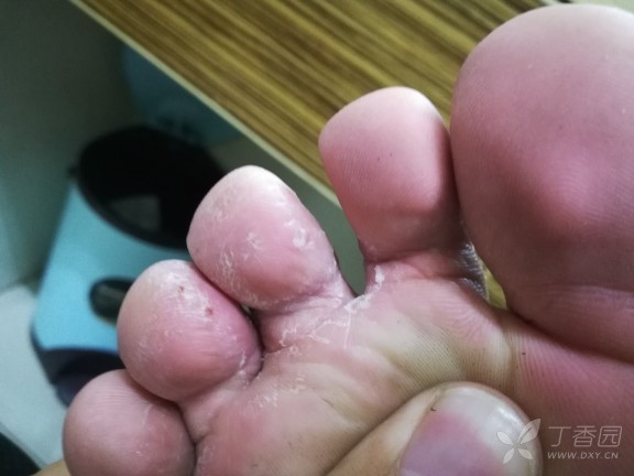 是梅毒早起症状吗?