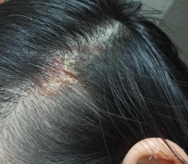 皮肤与性传播疾病讨论版 相关疾病: 皮肤癣菌病 头皮糠疹 头上长癣两