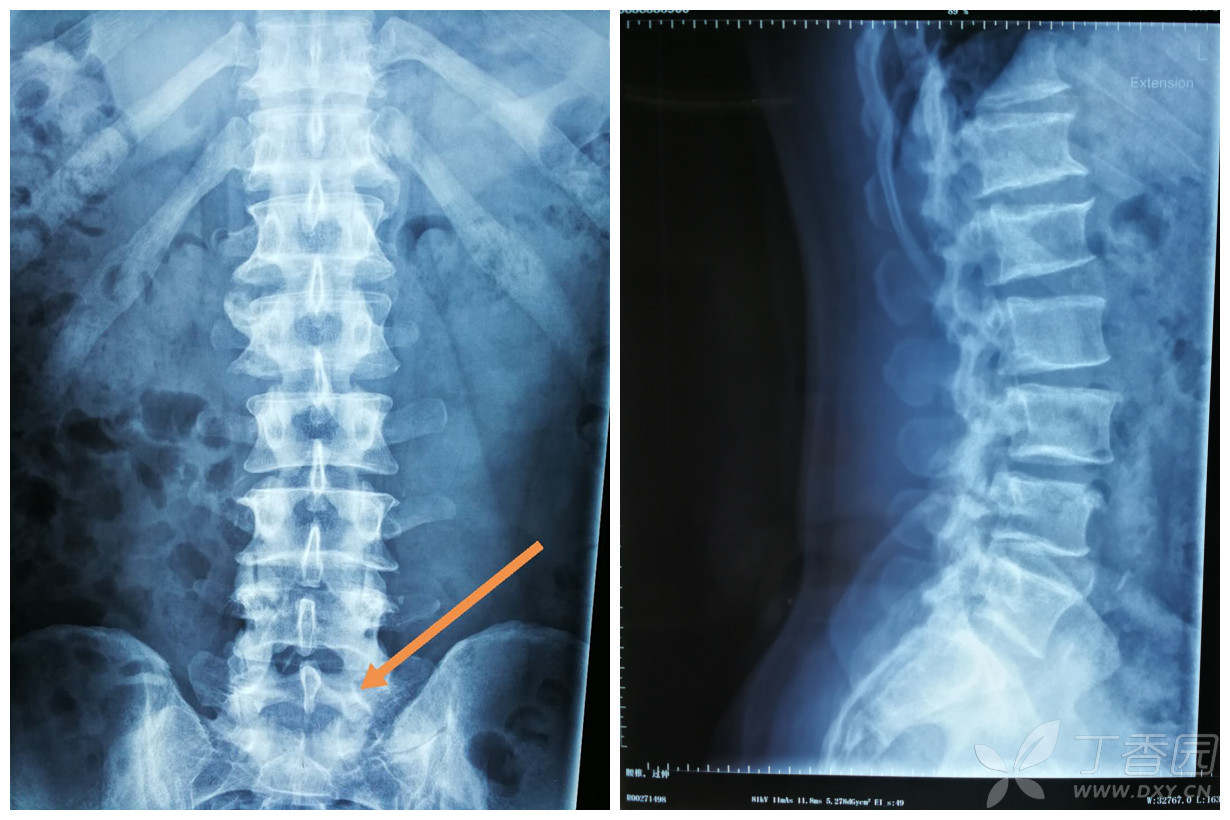 请大家看一例腰骶移行椎