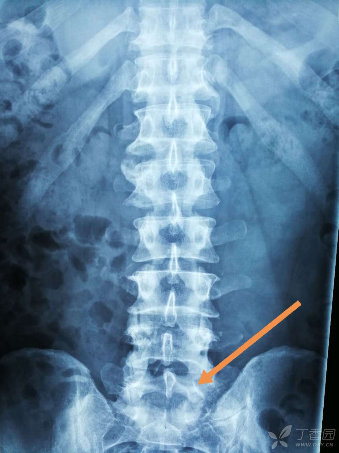 寰椎发育性椎管狭窄伴退变性颈脊髓病的影像学特点