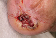 罕见病例：继发于创伤性瘢痕的血管肉瘤