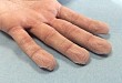 掌部水源性皱褶高发于囊性纤维化患者