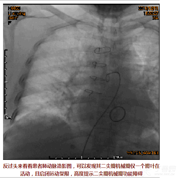 啥是二型呼吸衰竭 3270773108126461237-8w.png