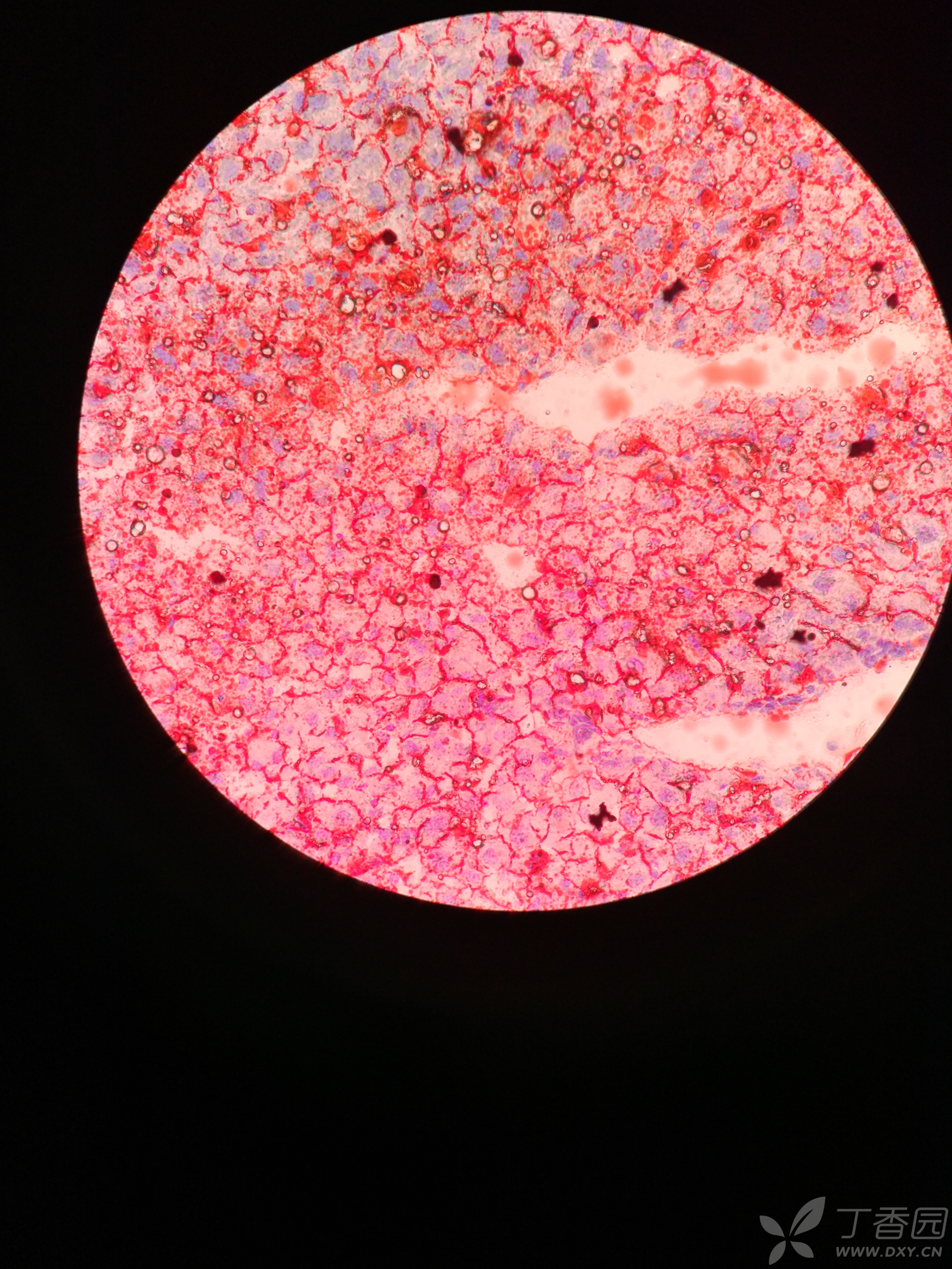 油红o染色是否成功,为什么会有裂纹