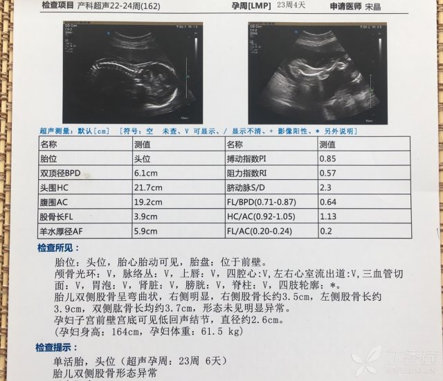 胎儿25周股骨弯曲