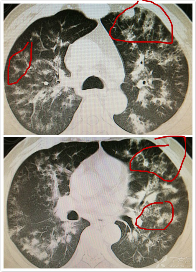 要關注這個,因為病毒性肺炎一般不形成空洞的,病毒性肺炎:肺泡水腫,被