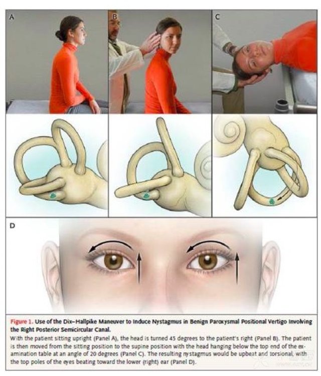 epley氏耳石复位手法flash