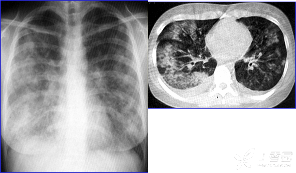 浸润性肺结核图片图片