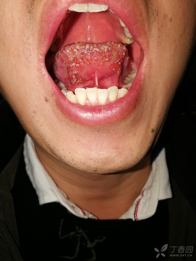 刚才见到的一个口腔粘膜病号,患者自觉灼烧样疼痛一月余,具体见图片