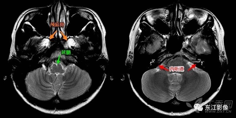 椎动脉颅内段是夹层动脉瘤好发区域,椎动脉闭塞也常见(图e,f).