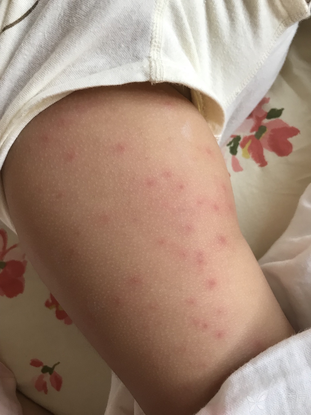 幼儿大面积虫咬性皮炎,经常反复是什么原因?