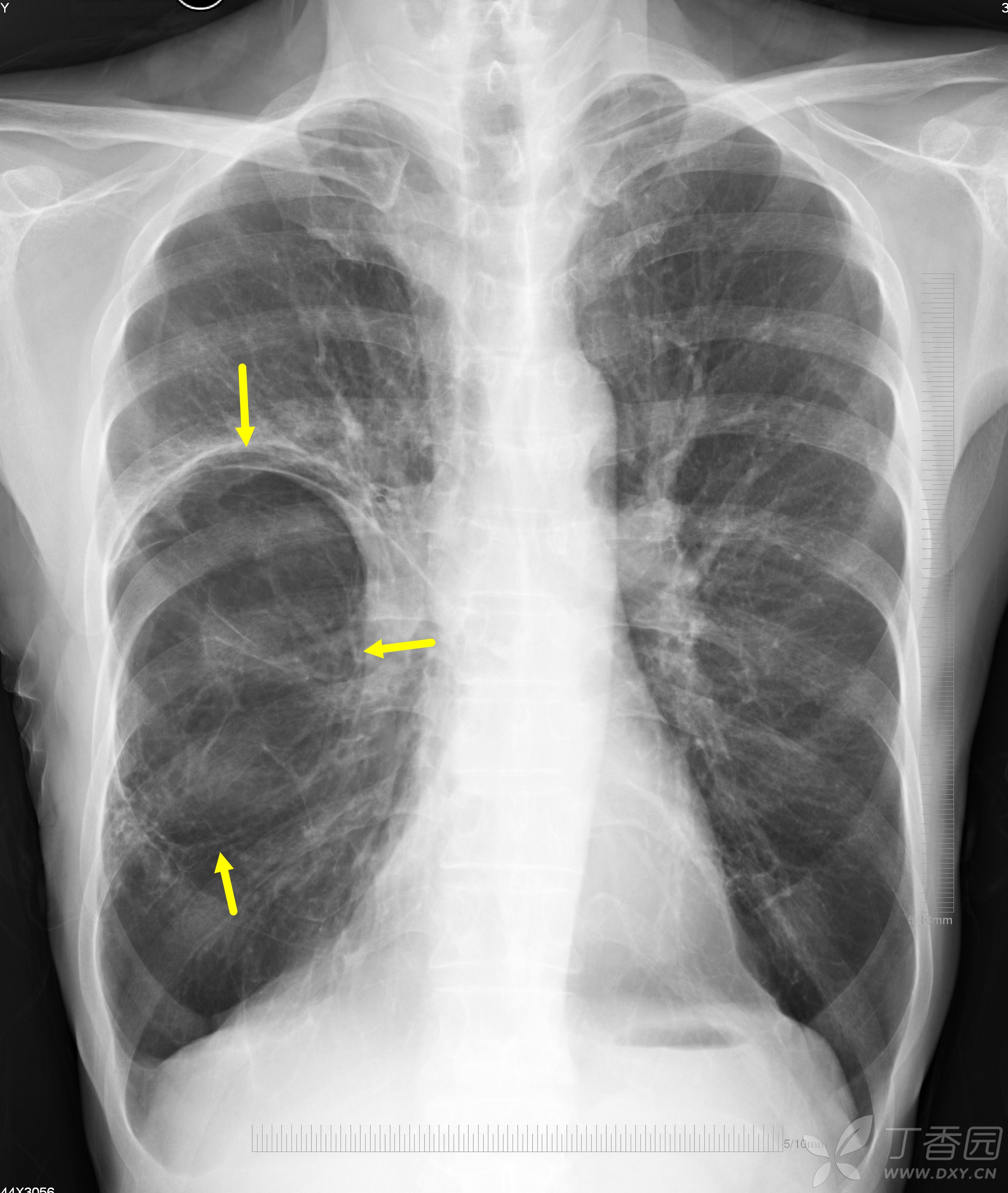 胸部 CT 入门:6 种最常见征象 + 相关疾病介绍 - 呼吸与胸部疾病讨论版 -丁香园论坛