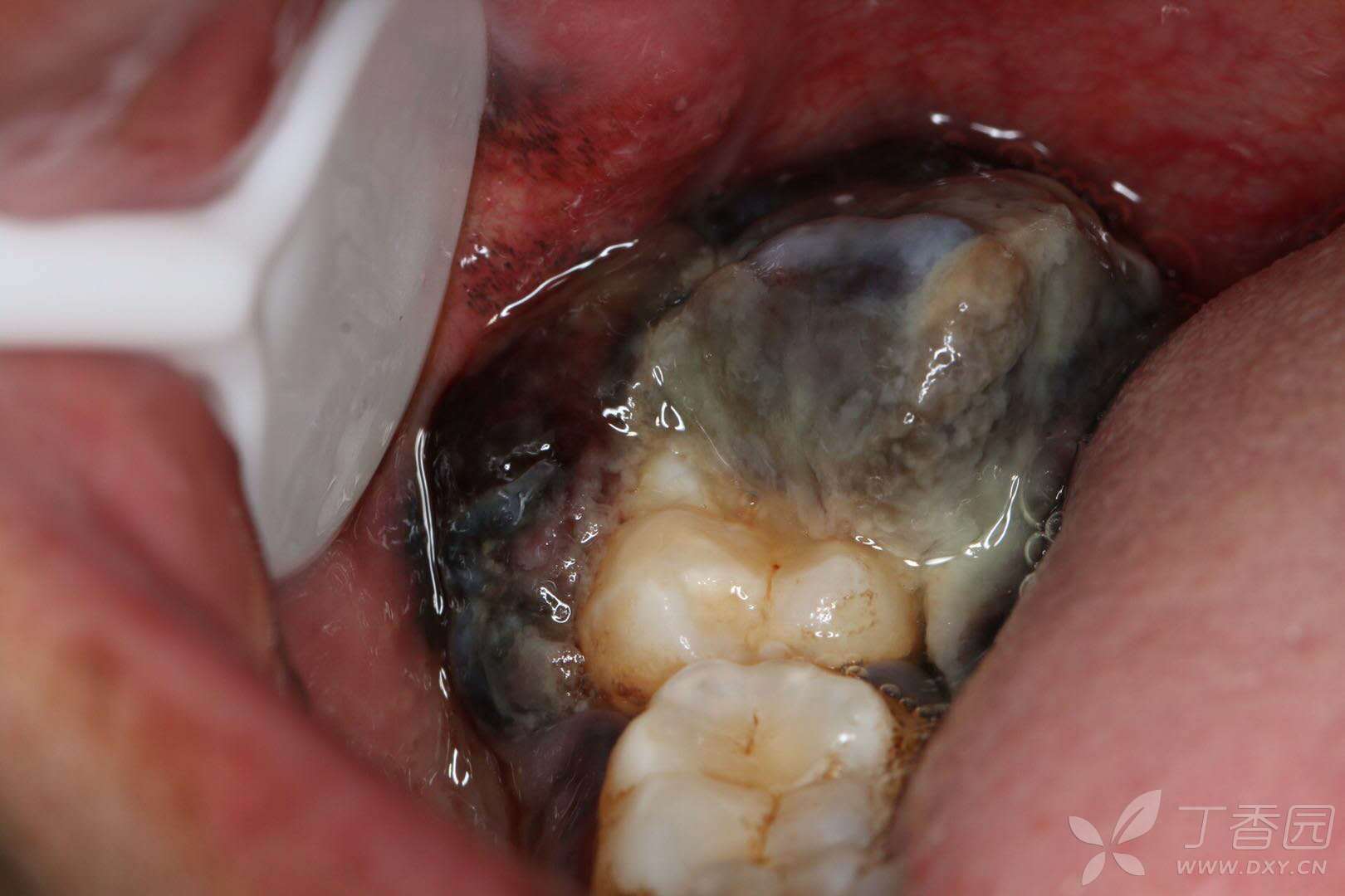 牙龈瘤照片图片