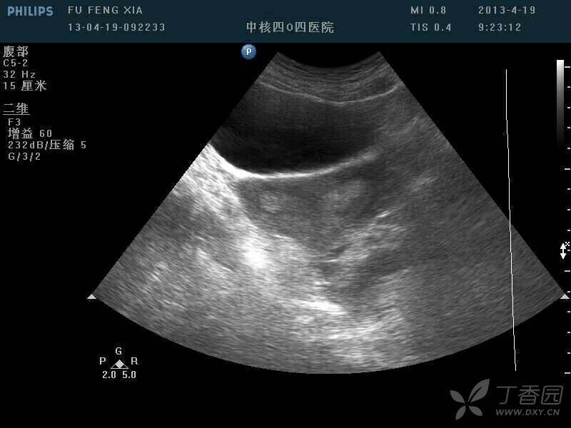 完全性纵膈子宫？双角子宫？双子宫？ - 丁香园论坛
