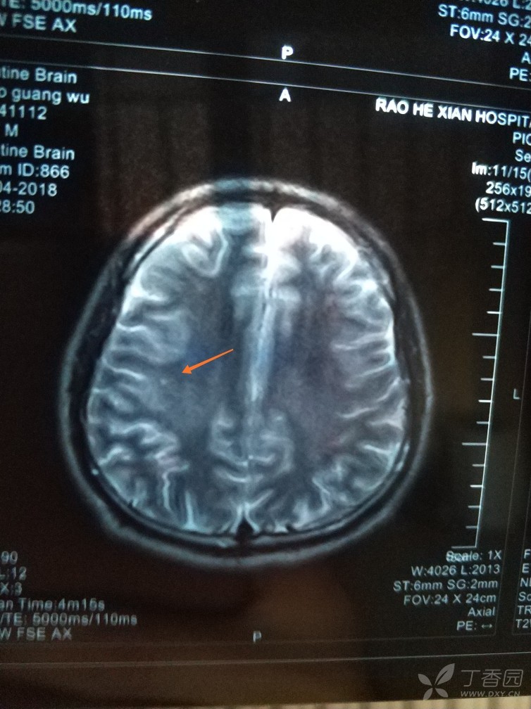 腔梗还是缺血灶