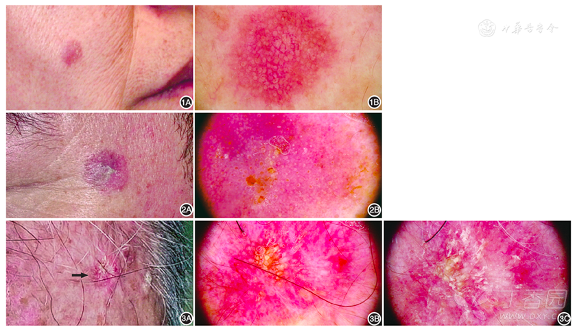 鳞状细胞肿瘤包括:光线性角化病(actinic keratosis,ak),鲍恩病(bowen