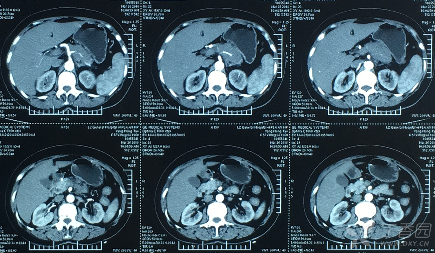 胰腺钩突癌图片