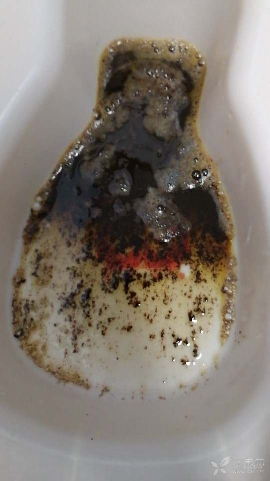 术后第3日下午再次呕吐咖啡色带渣液体.ob阳性.