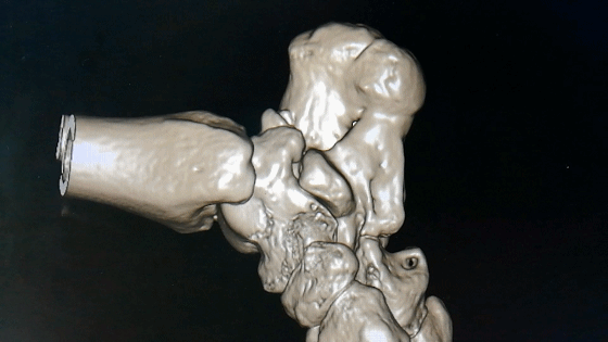 无语的跟骨骨折手术,术后创伤性关节炎,讨论治疗方案! [病例帖]