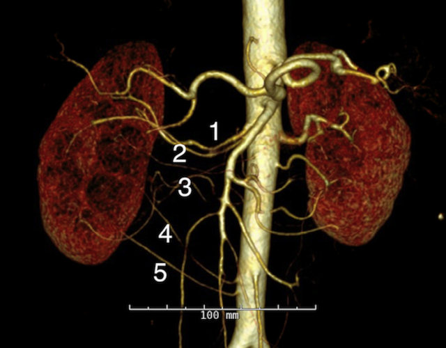 2 CT血管造影3维重建显示第3支肾动脉压迫右肾盂输尿管连接部.jpg