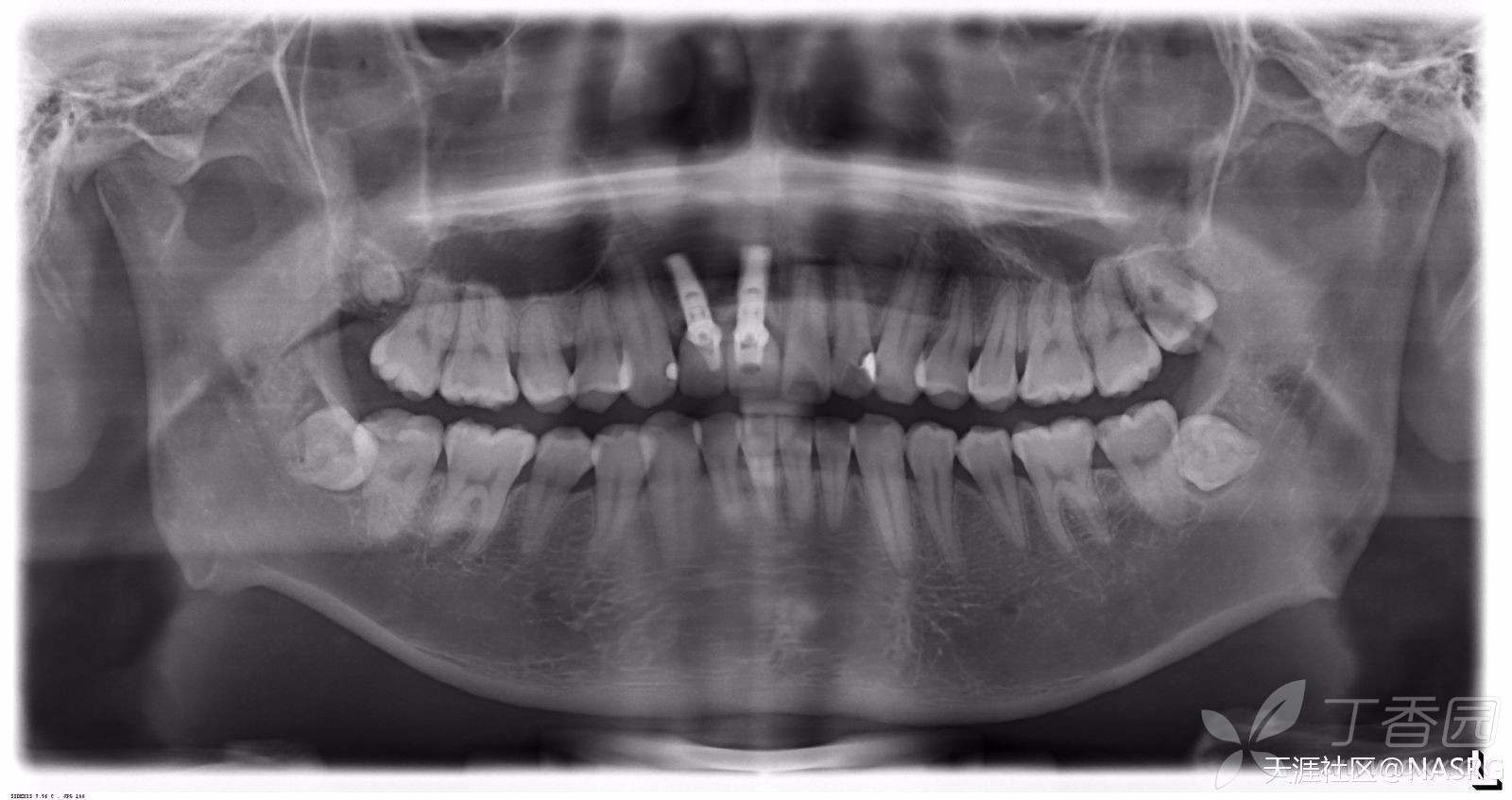 为什么左边右边骨头明显不对称了?