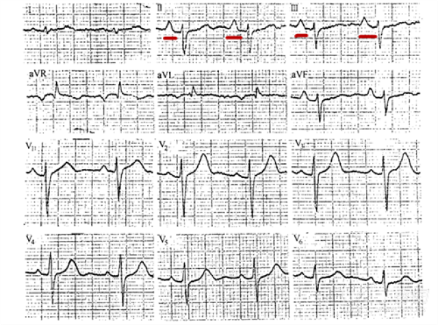 3,   肺性p波:即肢体导联p波振幅>0.