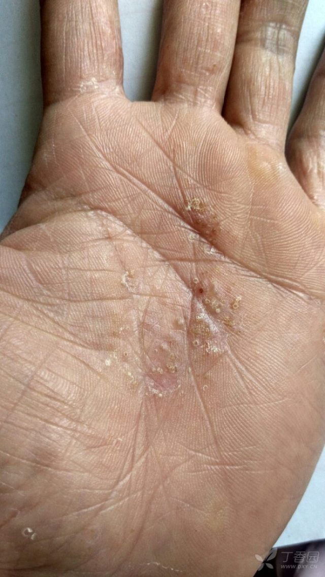 汗疱疹,求助