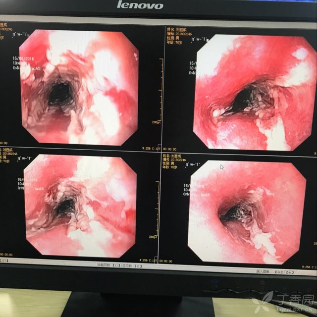 食管粘膜覆着白苔