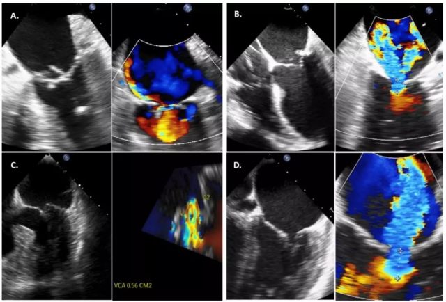 二尖瓣反流轻度 TAVR 手术可改善二尖瓣反流