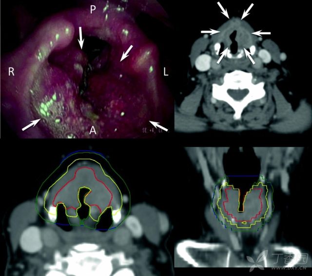 下咽癌解剖图片