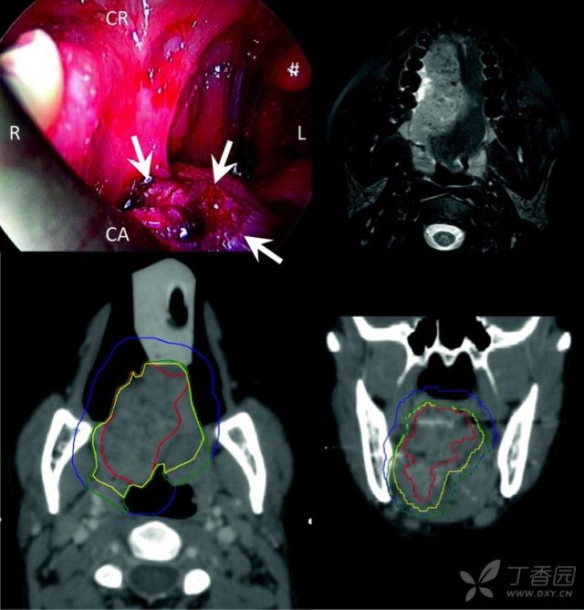 软腭乳头状瘤图片