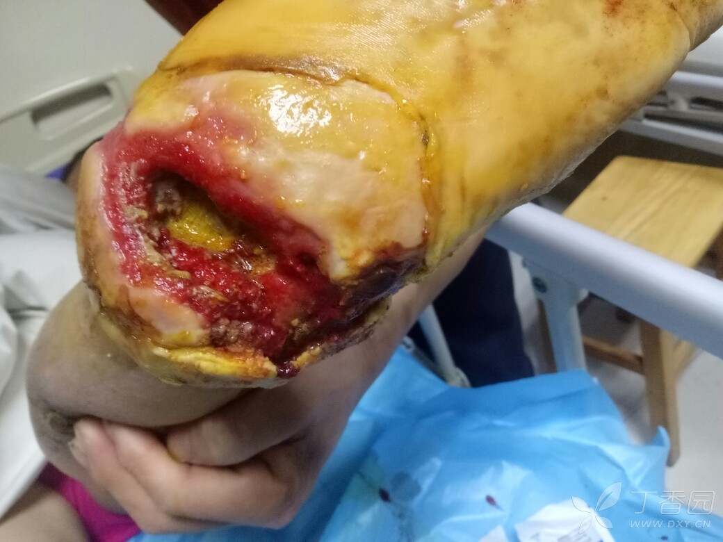 失去知觉,如今左脚溃烂不堪,恶臭,双脚有血运,今晚彻底清创后图片如下